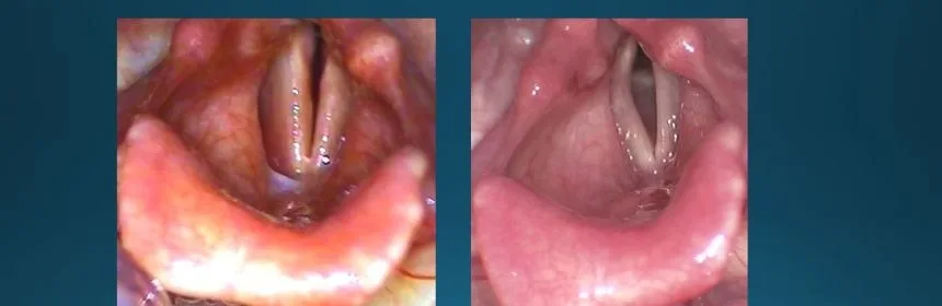 The vocal cords of a patient with bilateral vocal cord paralysis: before treatment on the left, after treatment on the right.