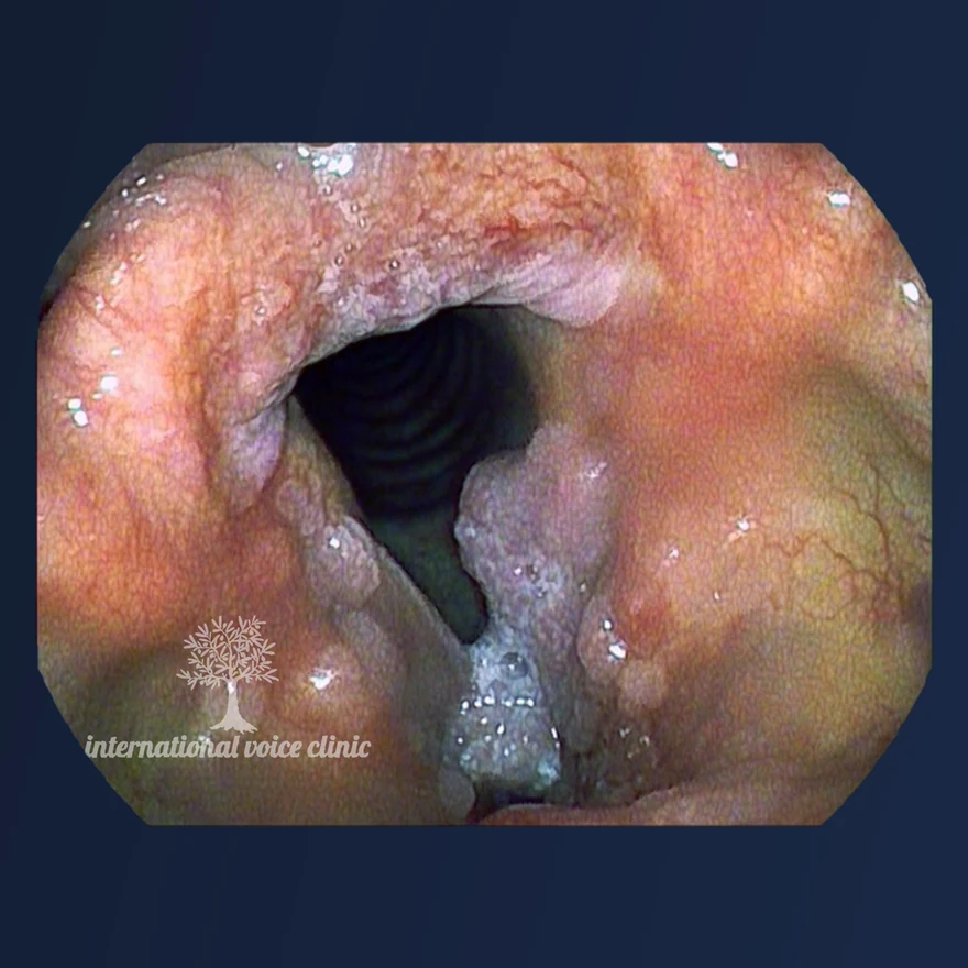 Endoscopic view of a larynx lined with thickened, irregular papillomatous tissue, leaving only a narrow airway through which the tracheal rings can be seen.