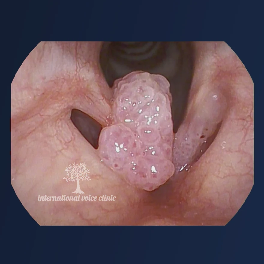 Endoscopic view of a bulky, knobbly papilloma growing out from a vocal fold and filling much of the gap between the vocal folds.