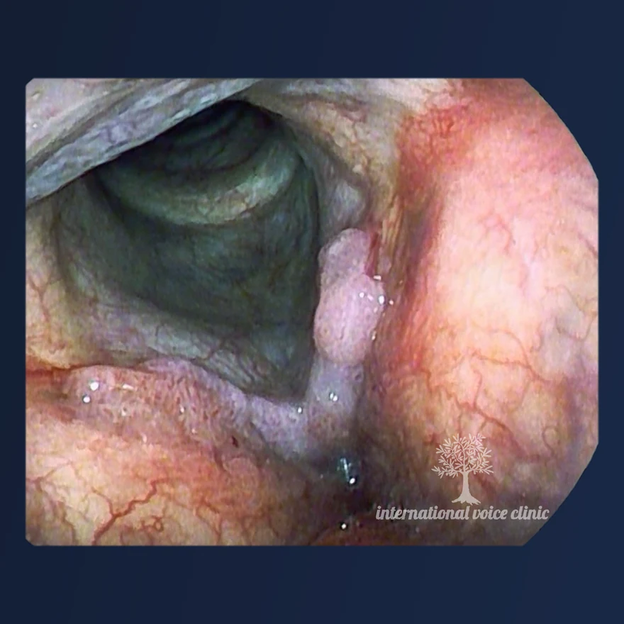 Image-enhanced endoscopic view in which a single small, pale papilloma at the edge of a vocal fold stands out against the surrounding lining, with the airway open below it.
