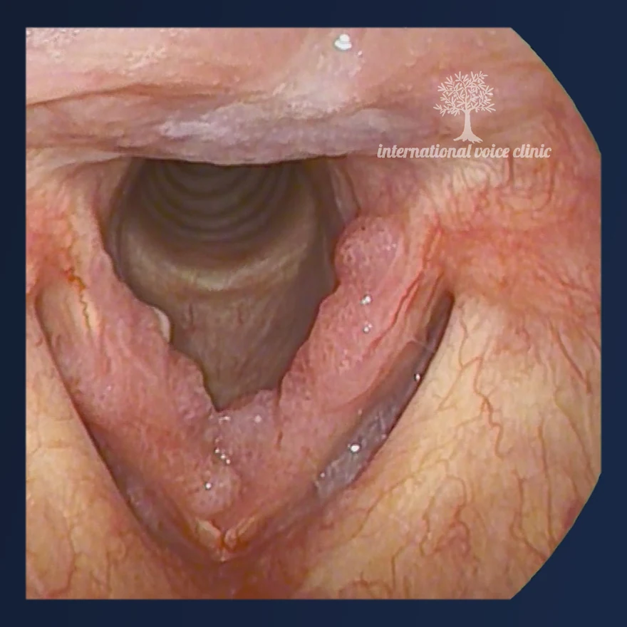 Endoscopic view of open vocal folds with a small, limited area of raised papillomatous tissue along the edge of one fold.
