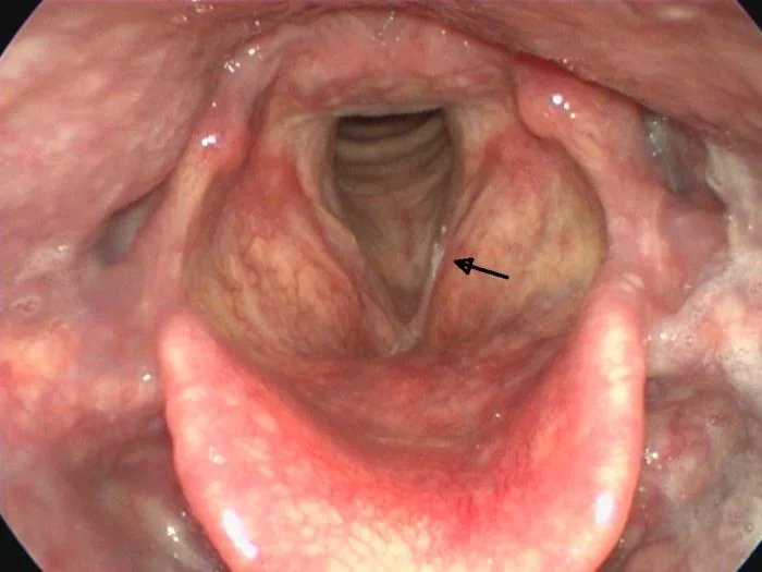 A pathological vocal cord lesion — a white lesion of the vocal cord (leukoplakia) indicating the onset of vocal cord cancer (carcinoma in situ).